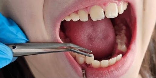 Tooth Extraction