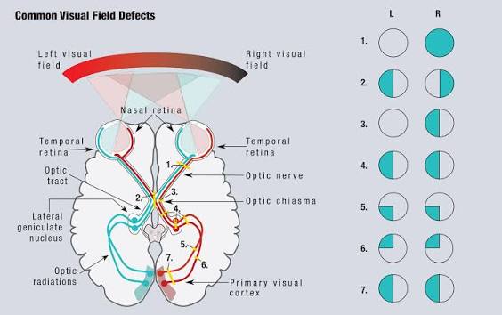 Visual Field Defect Localization