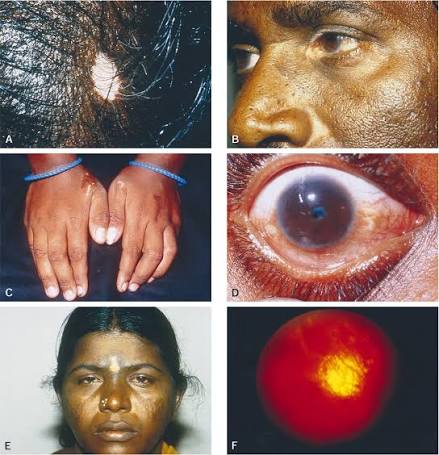 Vogt-Koyanagi-Harada Disease